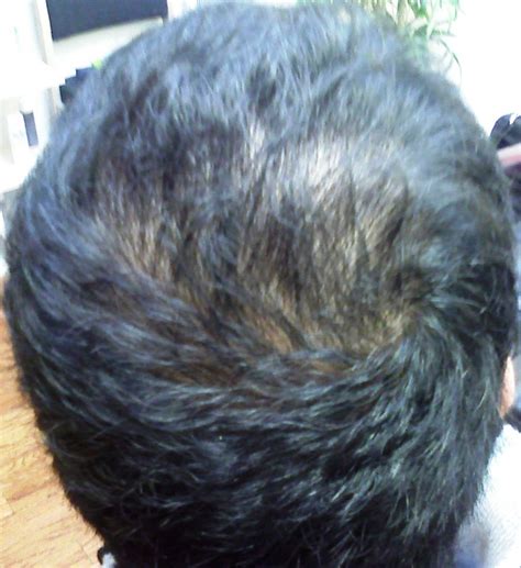 Signs and symptoms of hair loss may include: The Hair Loss Centre | Male Hair Loss Treated Successfully ...