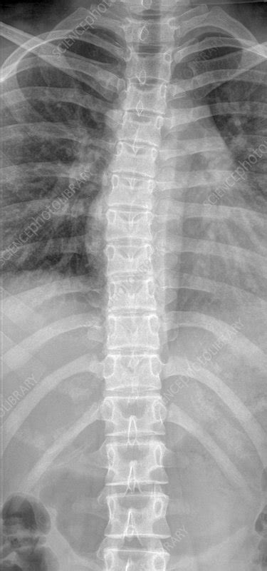 Normal Spine And Rib Cage X Ray Stock Image C0023273 Science