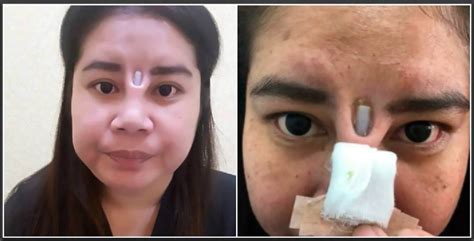 Botched Nose Job Leaves Woman With Silicone Implant Sticking Out Of Her