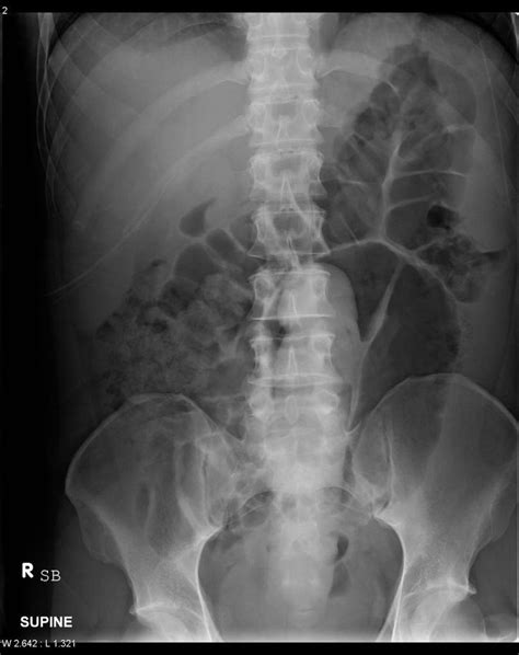 Rectal Foreign Bodies Are Not Uncommon In Emergency Departments Around The World And Although