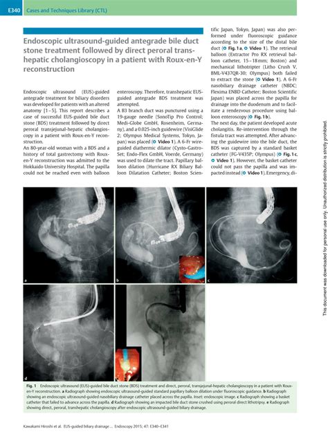 Pdf Endoscopic Ultrasound Guided Antegrade Bile Duct Stone Treatment