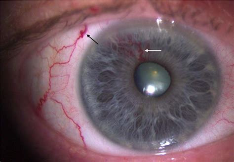 Arteriovenous Malformation Of The Iris The Bmj