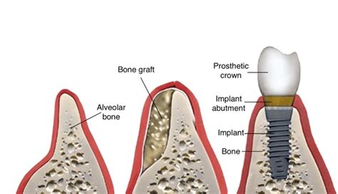 Bone Grafting For Dental Implants In San Diego University Dental