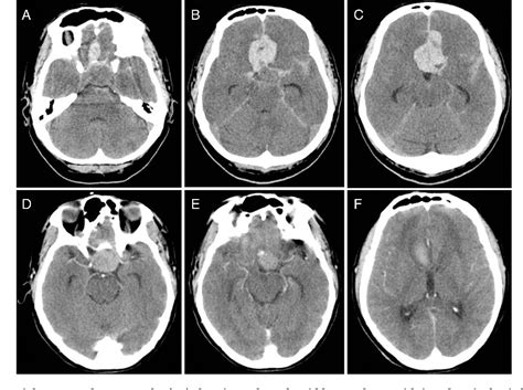 Figure 1 From Spontaneous Subarachnoid Haemorrhage From Rupture Of An