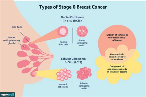 Dcis (ductal carcinoma in situ) is noninvasive in nature which means that the disorder did not spread out or affected other parts of the body. Stage 0 Breast Cancer: Diagnosis, Treatment, and Survival