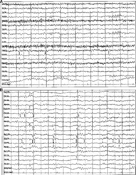 Figure 1 From Speech And Language Deterioration In Benign Rolandic