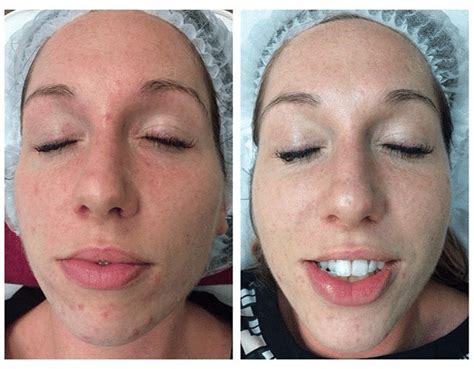 Skinbase Transformation Time October 14th 2015 Skinbase Facial