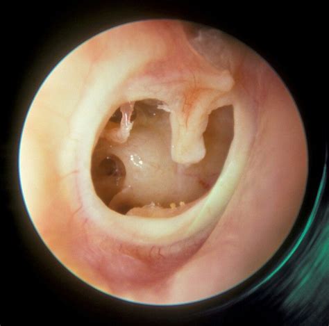 Pin By Html Css On Anatomy Otitis Media Otitis Ear Infection