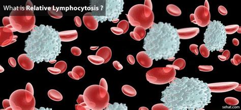 Relative Lymphocytosis Causes Symptoms Treatment