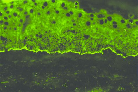 Bullous Pemphigoid Direct Immunofluorescence Showing Linear Deposits