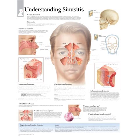 Sinusitis Sinus Disease Headache Remedies