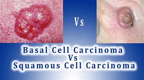 Basal Cell Carcinoma Vs Squamous Cell Carcinoma Bcc Vs Scc