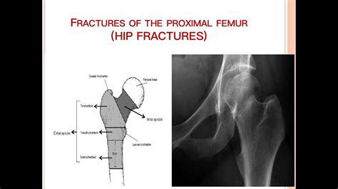 Fracture Of Proximal Femur Youtube