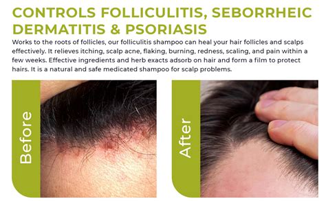 Anti Fungal Folliculitis Shampoo Seborrheic Dermatitis