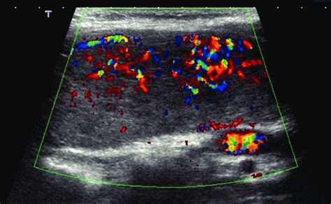 Ultrasound Of The Thyroid Showing An Intense Vascularity On Color