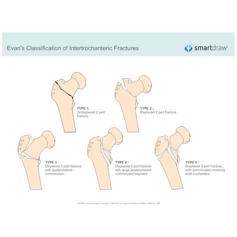 Evan S Classification Of Intertrochanteric Fractures