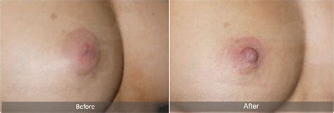 Inverted Nipple Correction Surgery Private Clinic London Birmingham