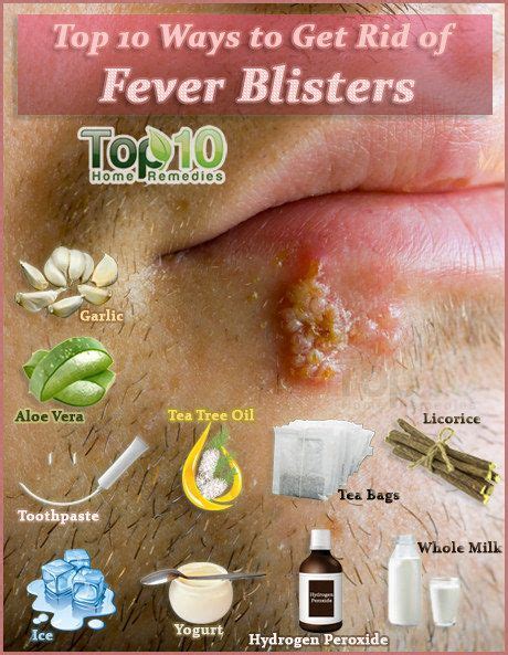 6 natural home remedies for fever blisters artofit