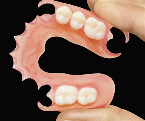 Removable Partial Dentures Ottawa Dental Laboratory Llc