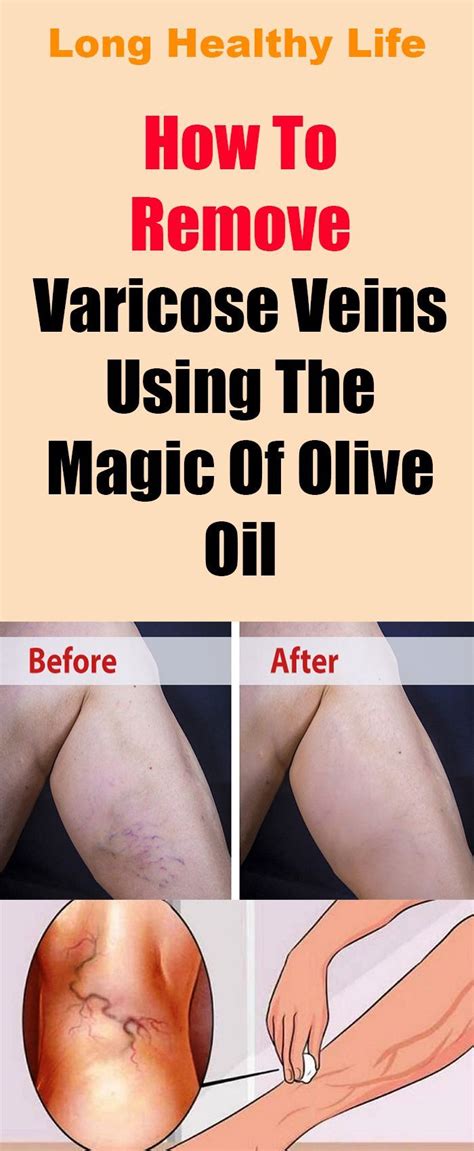 How To Remove Varicose Veins Using The Magic Of Olive Oil