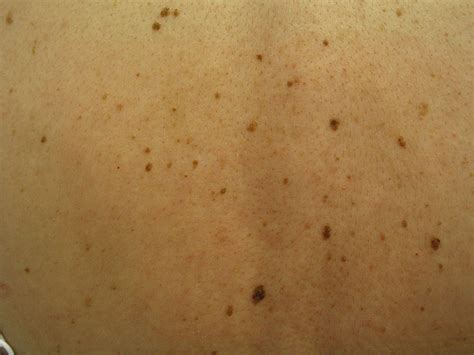 What Skin Cancer Moles Look Like