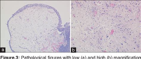 Figure 3 From A Case Of Polypoid And Papillary Cystitis Mimicking An