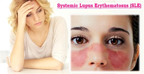 Systemic Lupus Erythematosus Sle Medicoinfo