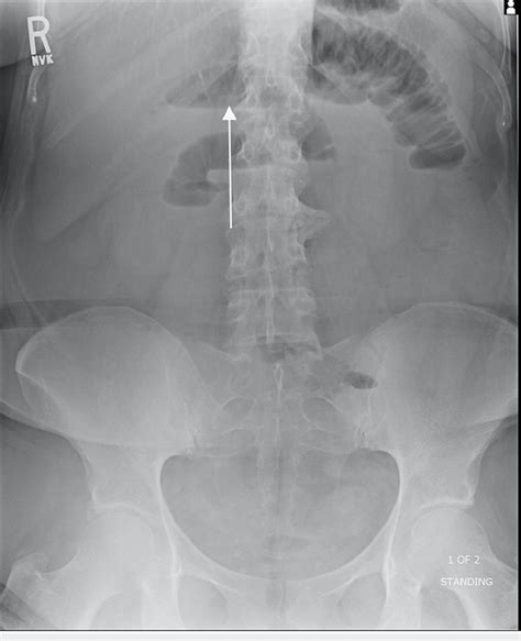 Abdominal Radiograph Of The Upright Frontal View Of The Abdomen