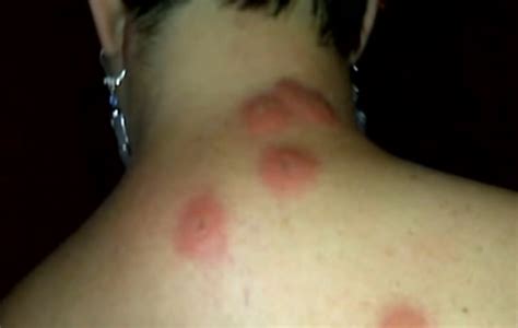 Bed Bug Bites Pictures Symptoms Causes Treatment Hubpages