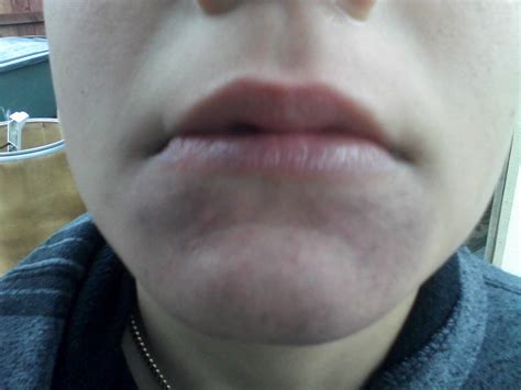 My 12 Yr Developed This Sudden Rash On His Chin But It Looks