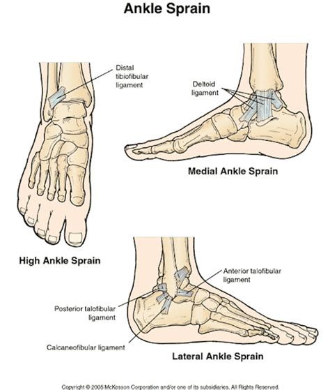 Even a complete ligament tear can heal without surgical repair if it is immobilized. sprain | Tumblr