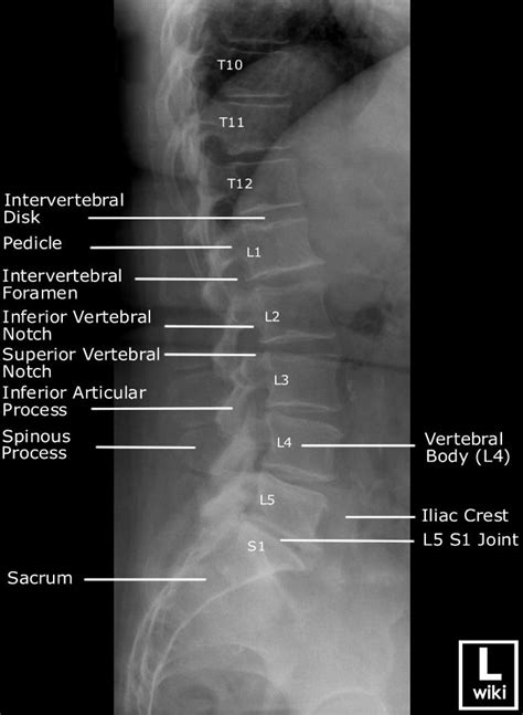 Lumbar Spine Radiographic Anatomy WikiRadiography Radiology Imaging