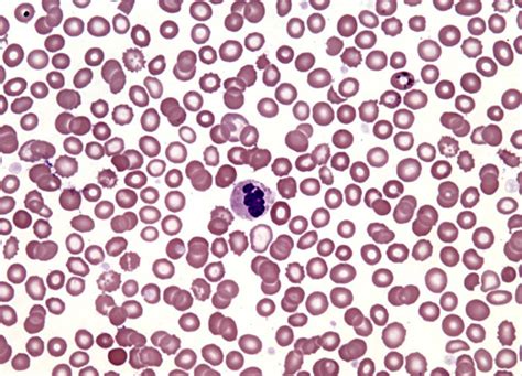 Iron Deficiency Anemia at 40x Magnification | MicroscopyU