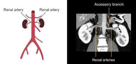 Abdominal Ct Abdominal Arteries Litfl Radiology Library