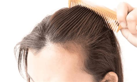 In the most common type of permanent hair loss, only the top of the head is affected. What Are the Best Hair Loss Treatment Options For Women?