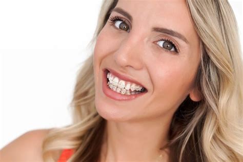 What You Need To Know About Adult Braces Dr Carr Orthodontics