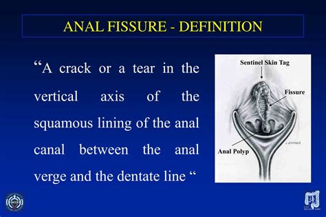 Ppt Treatment Of Anal Fissures Powerpoint Presentation Free Download Id 332663