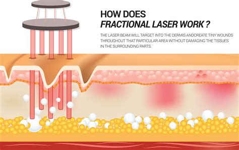 Fractional Laser - Dr.Tony Beauty expert