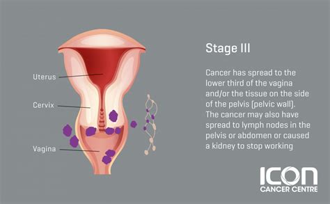 Some women exhibiting early stages of cervical cancer experience swelling and pain in the leg. Cervical Cancer — Icon Cancer Centre Singapore