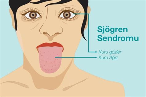 Sjögren Sendromu Nasıl Bir Hastalıktır Tükürük Bezleri Dışında Hangi