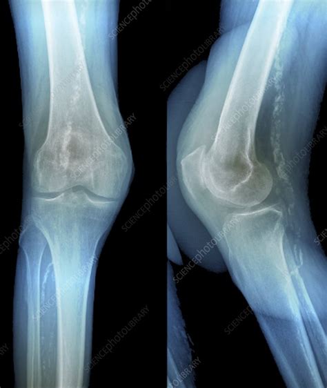 Osteoarthritis Of Knee Cap X Ray Stock Image C0026534 Science