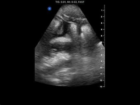 Butterfly iq+™ is a product manufactured by butterfly network, inc. luthfiannisahay: Butterfly Iq Diagnostic Ultrasound Canada