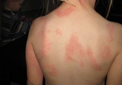 Learn more about hives including symptoms of hives and causes of widespread hives, as well as when to seek care. Hives. Causes, symptoms, treatment Hives