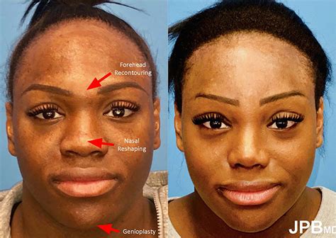 facial feminization surgery new york city ffs great neck
