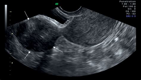 Chapter 4 Sonographic Assessment Of Uterine Fibroids And Adenomyosis Obgyn Key