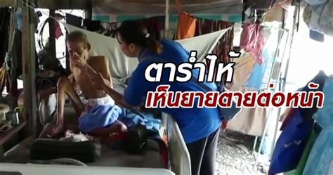 อัมพฤกษ์แขนขาสองข้าง, อัมพฤกษ์สี่ขา [แพทยศาสตร์ ๖ ส.ค. ตาเห็นยายเสียชีวิตต่อหน้า ร่ำไห้อย่างสะเทือนใจ ลุกไปช่วย ...