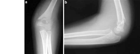 Type-II flexion supracondylar fracture in 5-year-old ...