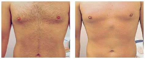 Because the elite+ system is so advanced, even if you weren't a candidate for laser hair removal before, you certainly could be now. Before and After | Renova Laser Hair Removal & MedSpa ...