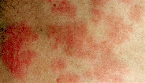 Rashes On The Back Of Neck Pictures Photos