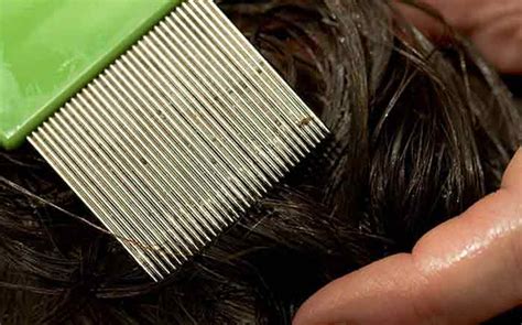 Check spelling or type a new query. How to Check Yourself for Lice-how to tell if you have ...